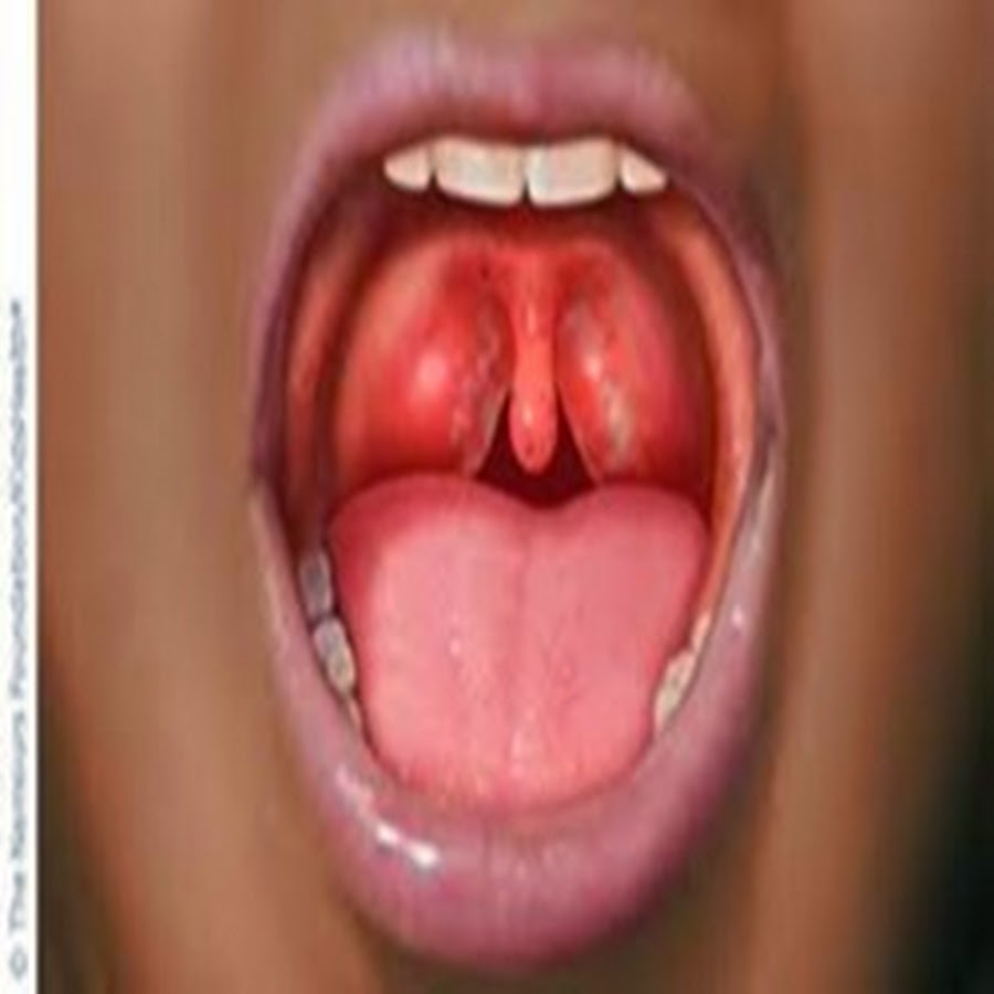 Early Signs Of Strep Throat 81