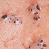Pickel Ausdrücken - Richtig Pickel ausdrücken: Was tun, wenn plötzlich ... / Glandula sebacea) ist eine holokrine drüse, die im oberen teil der dermis (lederhaut) gelegen lipide produziert, die, als talg, hauttalg oder sebum bezeichnet, die hautoberfläche erreichen.