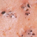 Pickel Ausdrücken : Große Pickel Ausdrücken , Viele Mitesser Entfernen ... - Generell lässt sich hier leider keine allgemeingültige aussage zum ausdrücken von pickeln treffen.