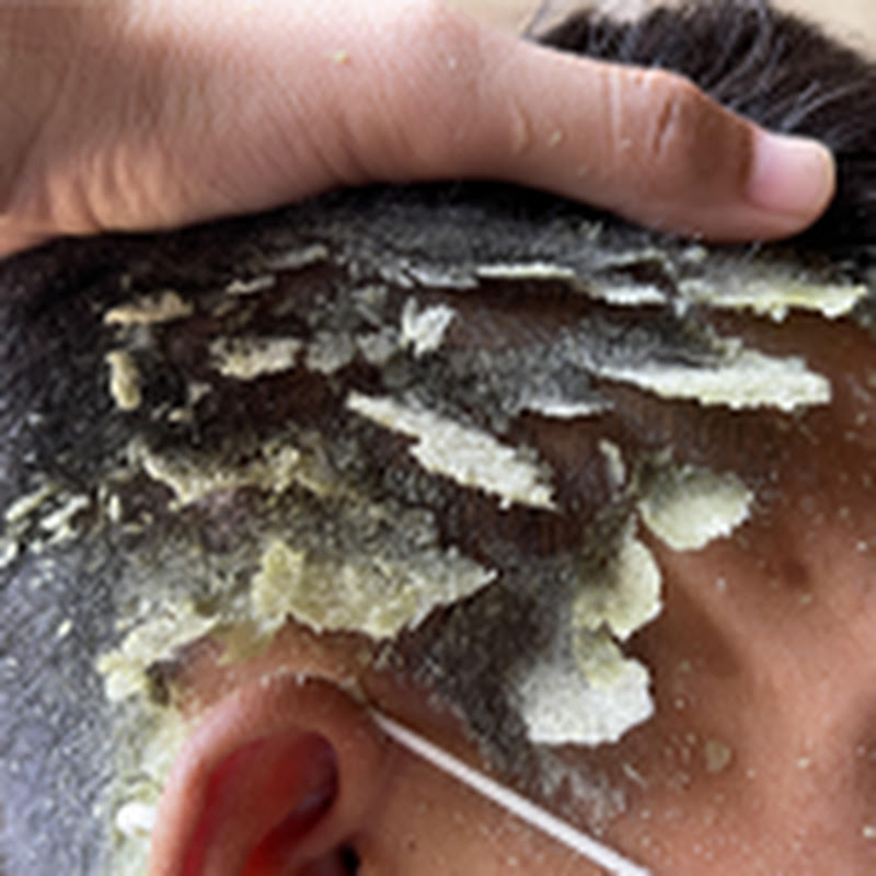 Scratching Dandruff