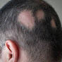 Alopecia areata logo