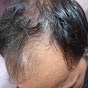 hair regrow without operation logo