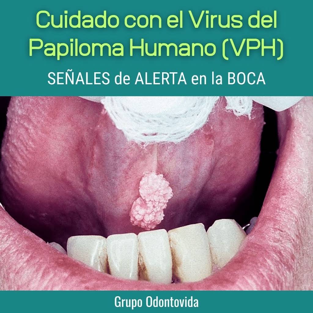 Virus Papiloma Humano Boca