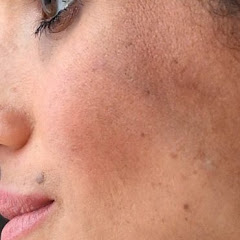 Meghan’s Mole Avatar