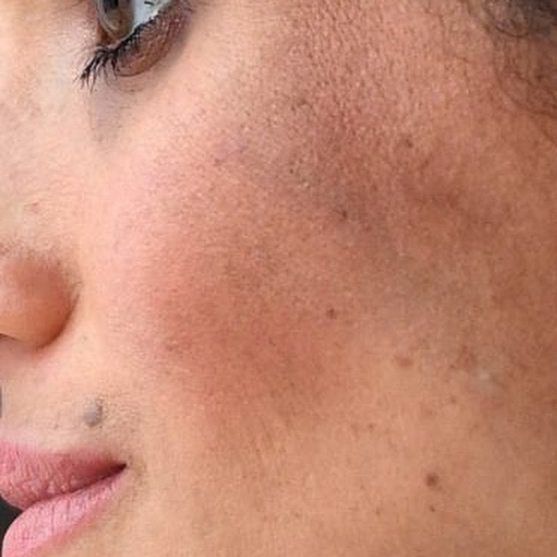 Meghan’s Mole