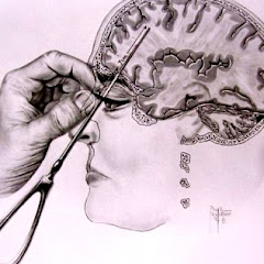 Lobotomizations