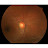 Retina and cataract Musha M