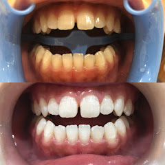 ぽんこつ｜顎変形症・歯列矯正記録アイコン画像