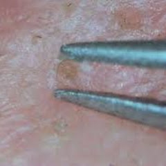 にゅるポン Second tweezers