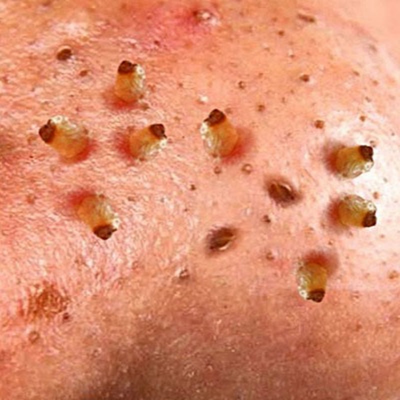 Ngoc Nguyen Acne Treatment
