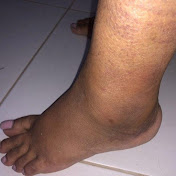 Sprained Ankles