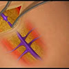 veintreatment
