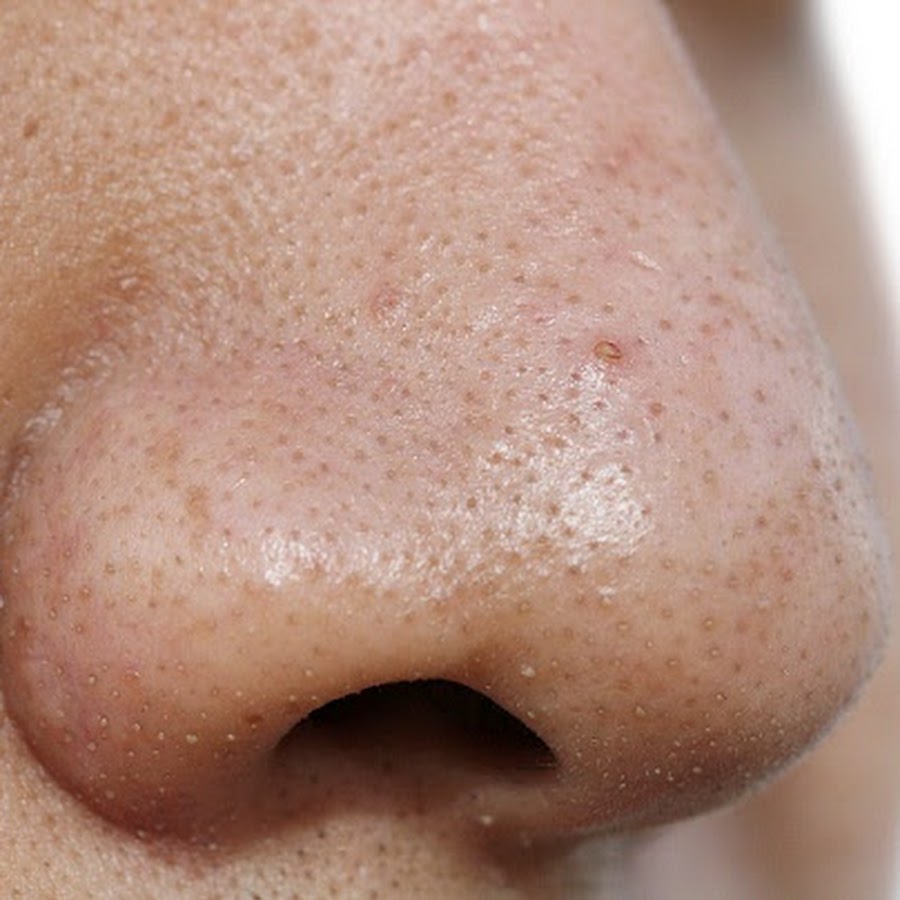 Remove Blackheads YouTube