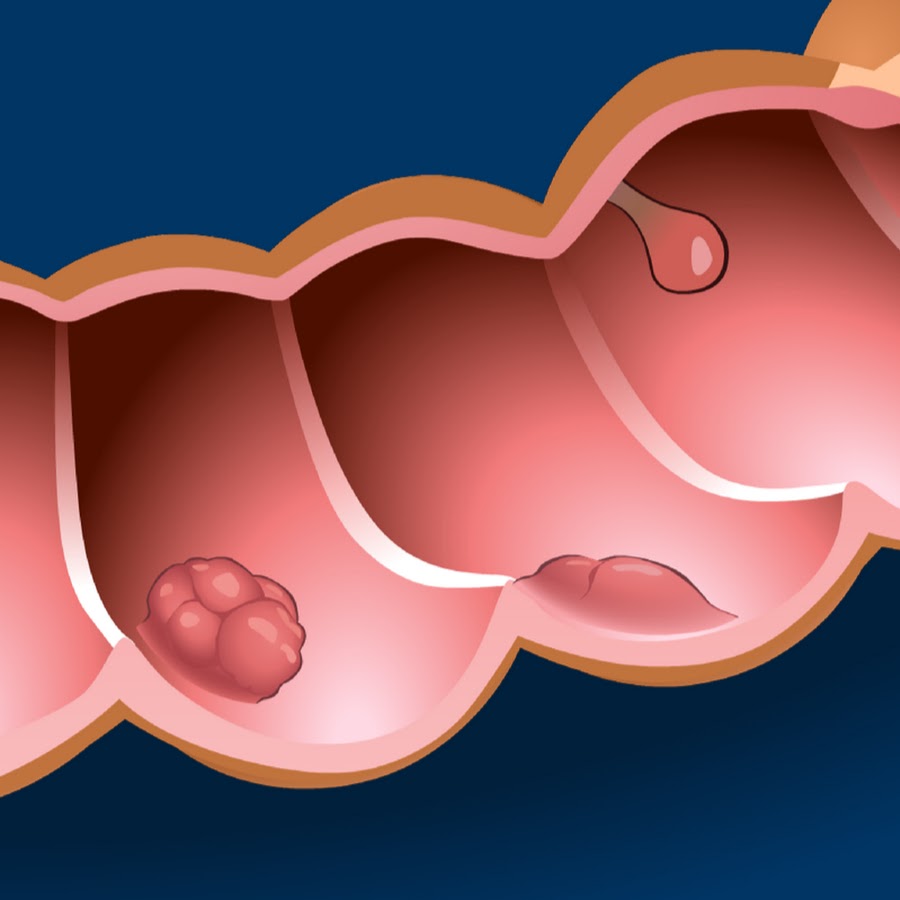 You and Colon Cancer - YouTube