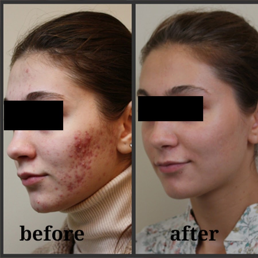 Acne treatment Spa - YouTube