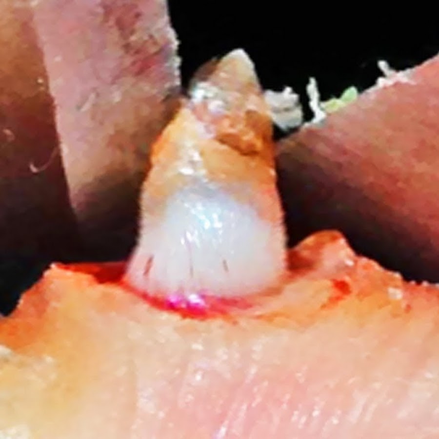 Top 5 Pimple Popping Videos 