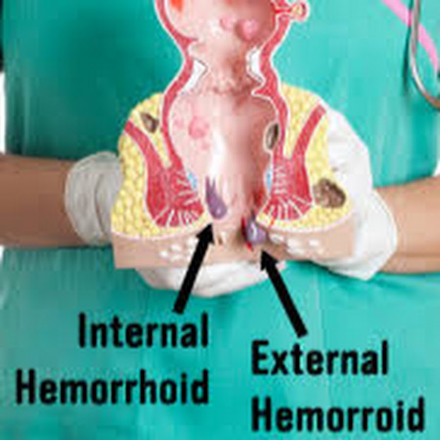 How To Treat A Hemorrhoid - YouTube