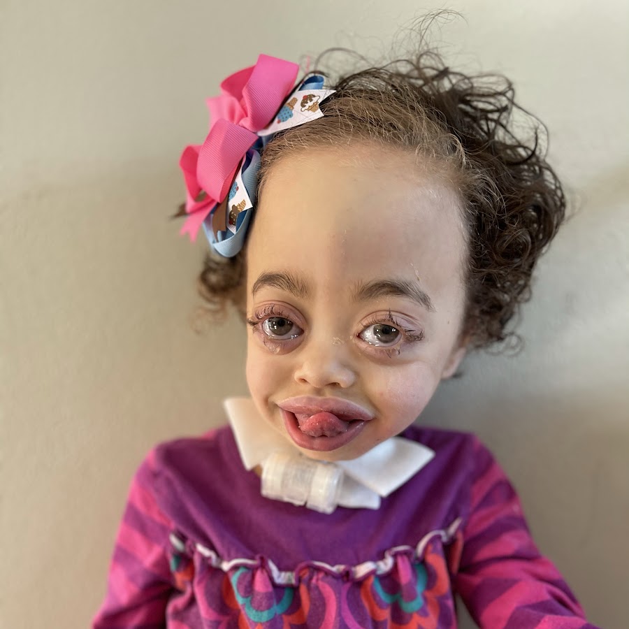 Phoenix's Life With Marshall Smith Syndrome - YouTube