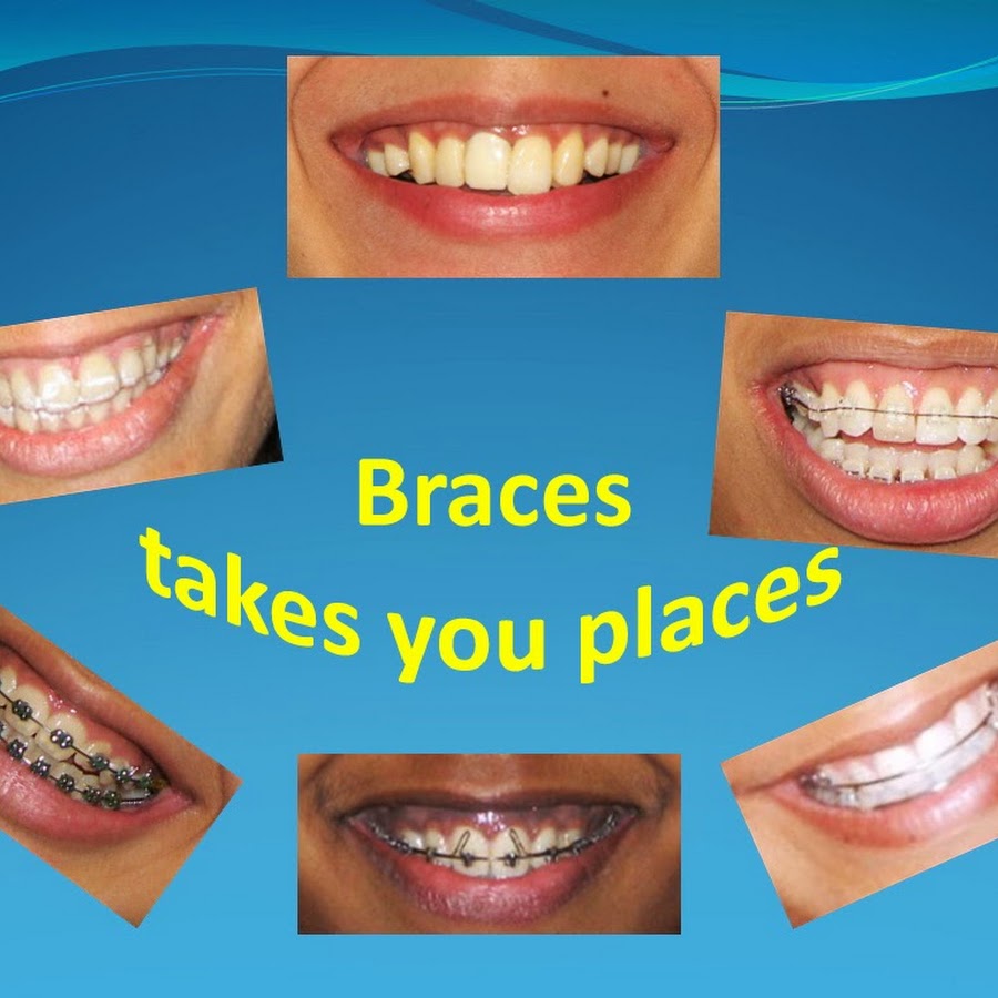Braces Takes U Places - YouTube
