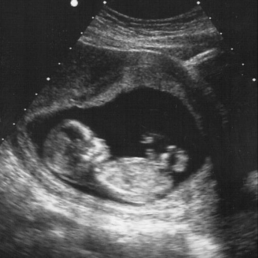 Беременность 13 мм. УЗИ 12-13 недель беременности. 13 Недель беременности фото плода на УЗИ. УЗИ 13-14 недель беременности. Снимок УЗИ плода 13 недель.