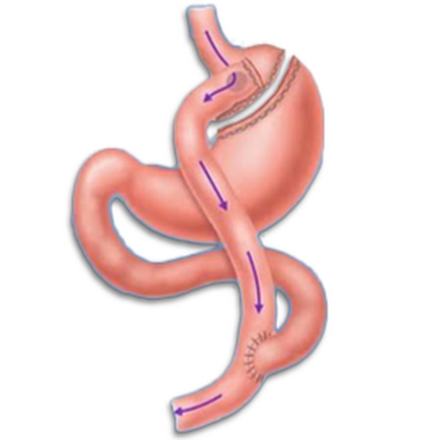 Шунтирование желудка это. Шунтирование желудка это. Операция гастрошунтирование. Гастрошунтирование (лапароскопическое шунтирование желудка. Шунтирование желудка это.