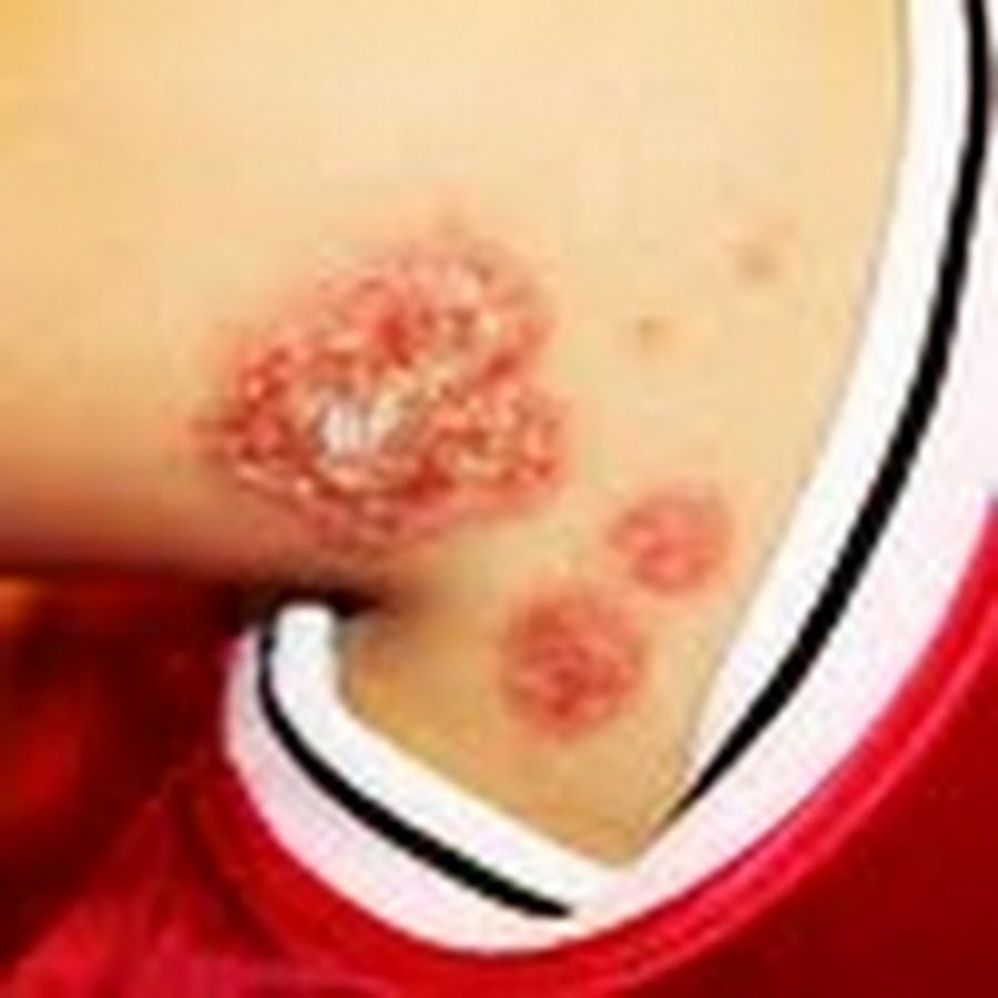 MRSATreatmentCure - YouTube