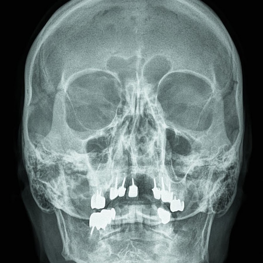 Снимок черепа. Рентгенография костей черепа норма. Норма костей черепа на рентгене.