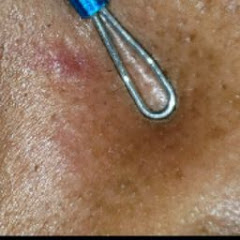 Ingrown Hair And Whitehead Extraction Ingrown Hair Whitehead