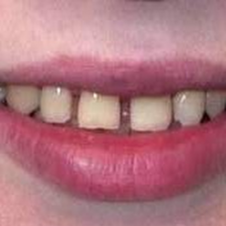 Какое расстояние между зубами. Диастема передних зубов.