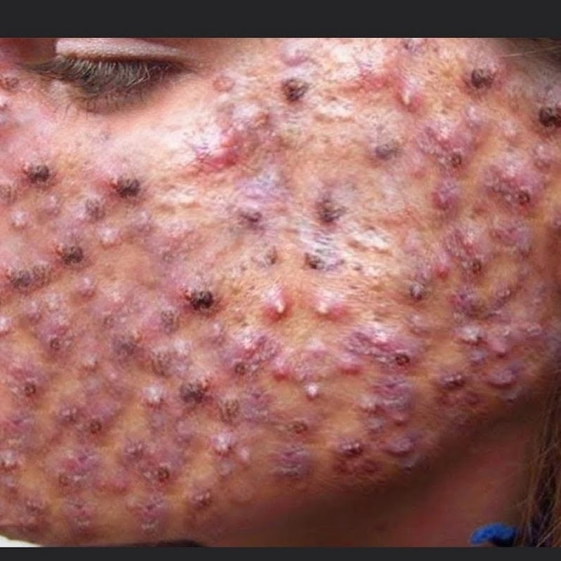 Granos y Espinillas 2024