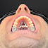 hl4N6JMZjd8-channel-avatar-Adult Maxillary Expansion Journey