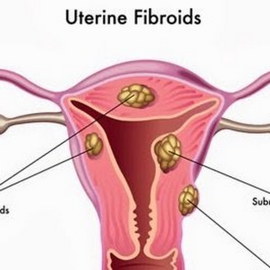 endometrial cancer natural treatment