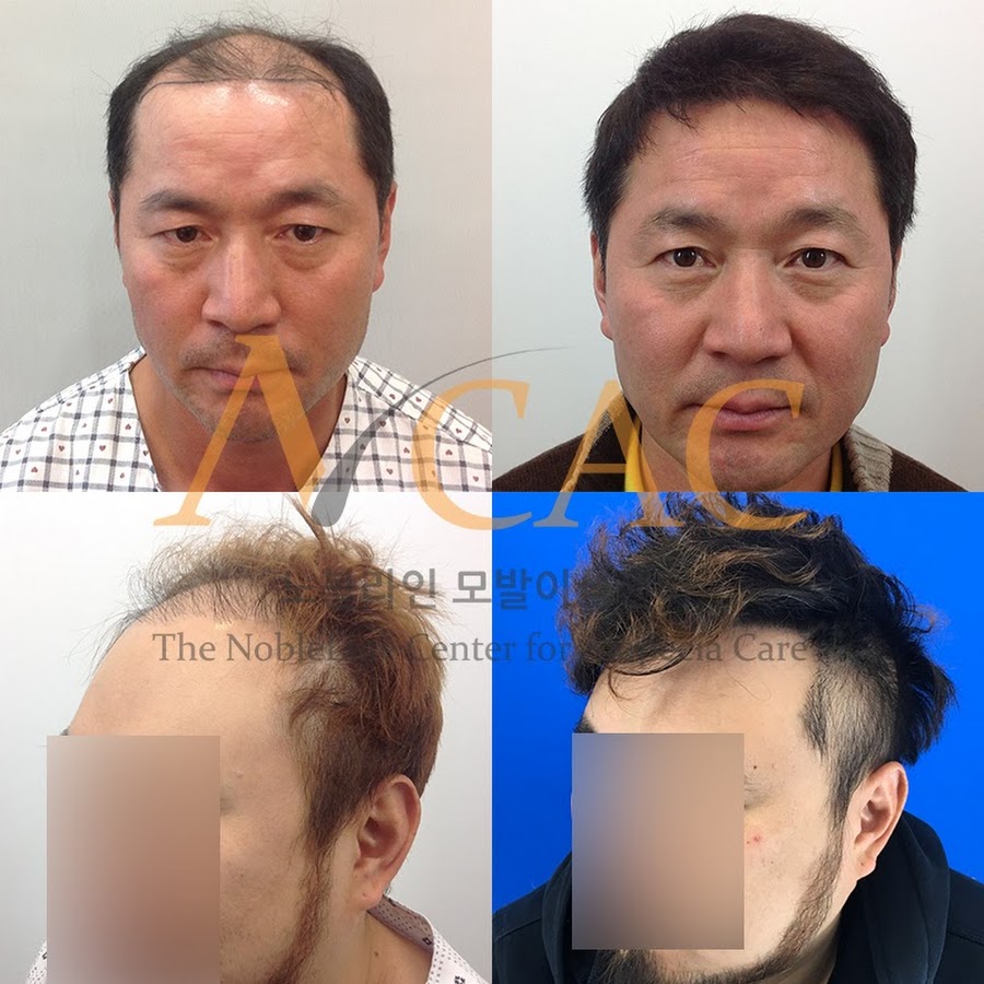 Nobleline hair transplant for Asian