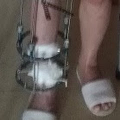 アルメニアでイリザロフ手術とLON法手術した経過アイコン画像