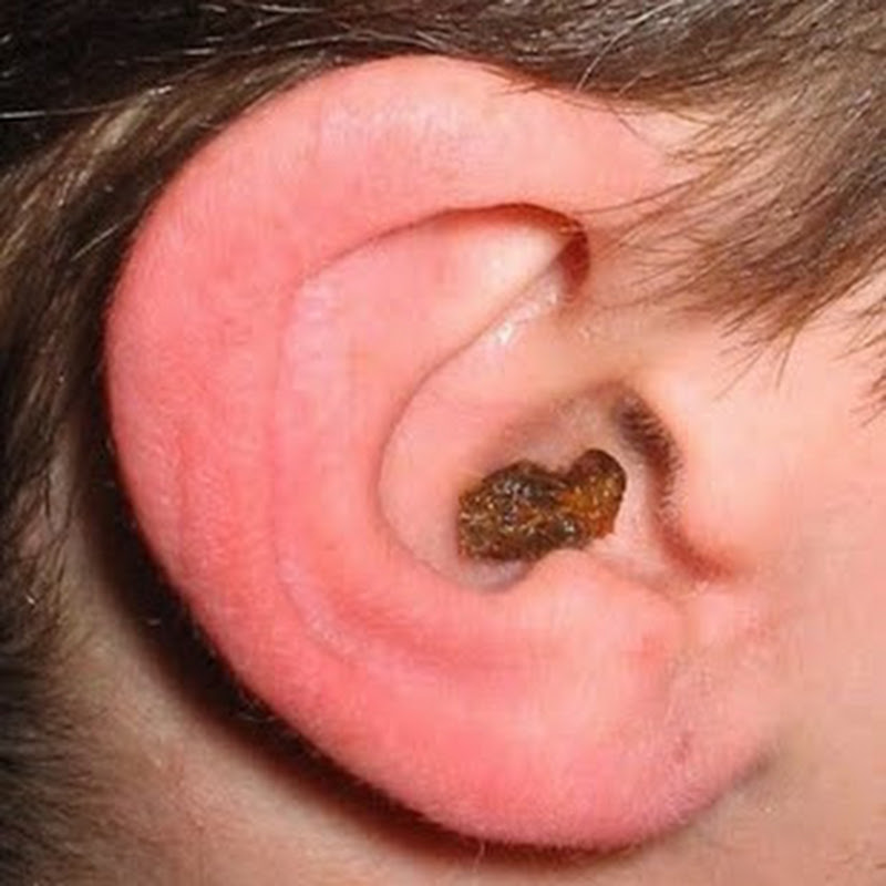 Skin Ear Bigwax
