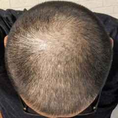 ケンゴAGA治療アイコン画像