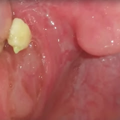 Weekly Tonsil Stone Popsアイコン画像