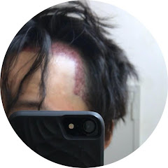 おでこに植毛したチャンネルアイコン画像