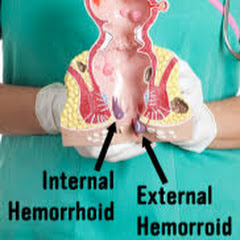 How To Treat A Hemorrhoid