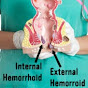 How To Treat A Hemorrhoid