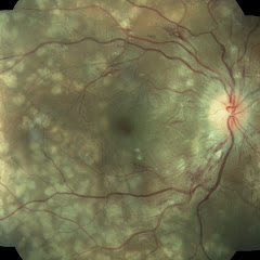 RETINA CALI