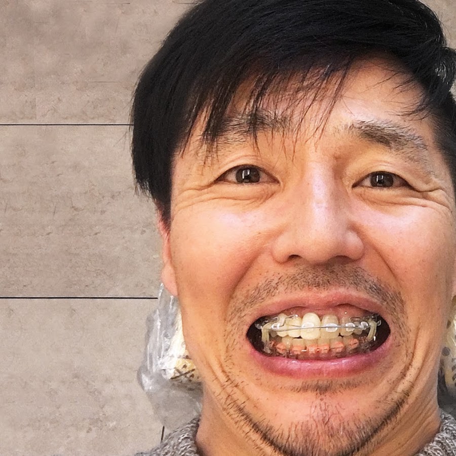 要注意 犬歯を削ると大変だよ 尖った犬歯を削った結果 八重歯