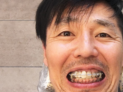 √99以上 犬歯 尖り すぎ てる 162344