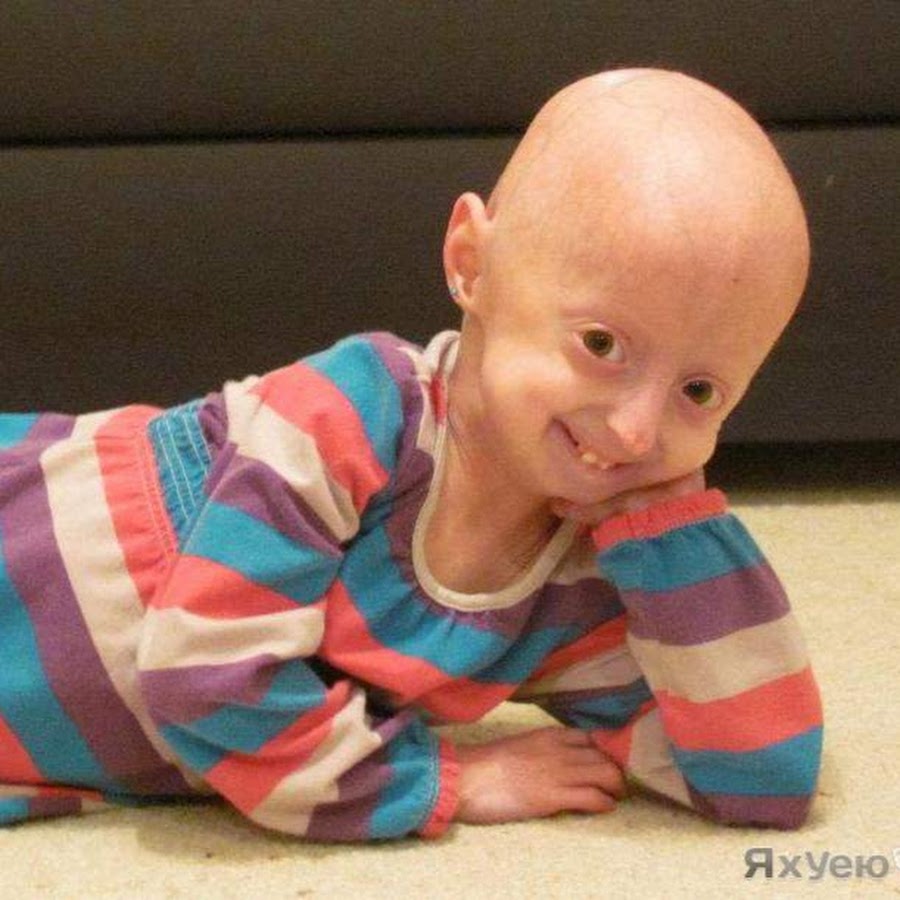 как называется детская болезнь. прогерией хатчинсона-гилфорда. прогерия (синдром гетчинсона-гилфорда). прогерии хатчинсона-гилфорда. прогерия болезнь прогерия.