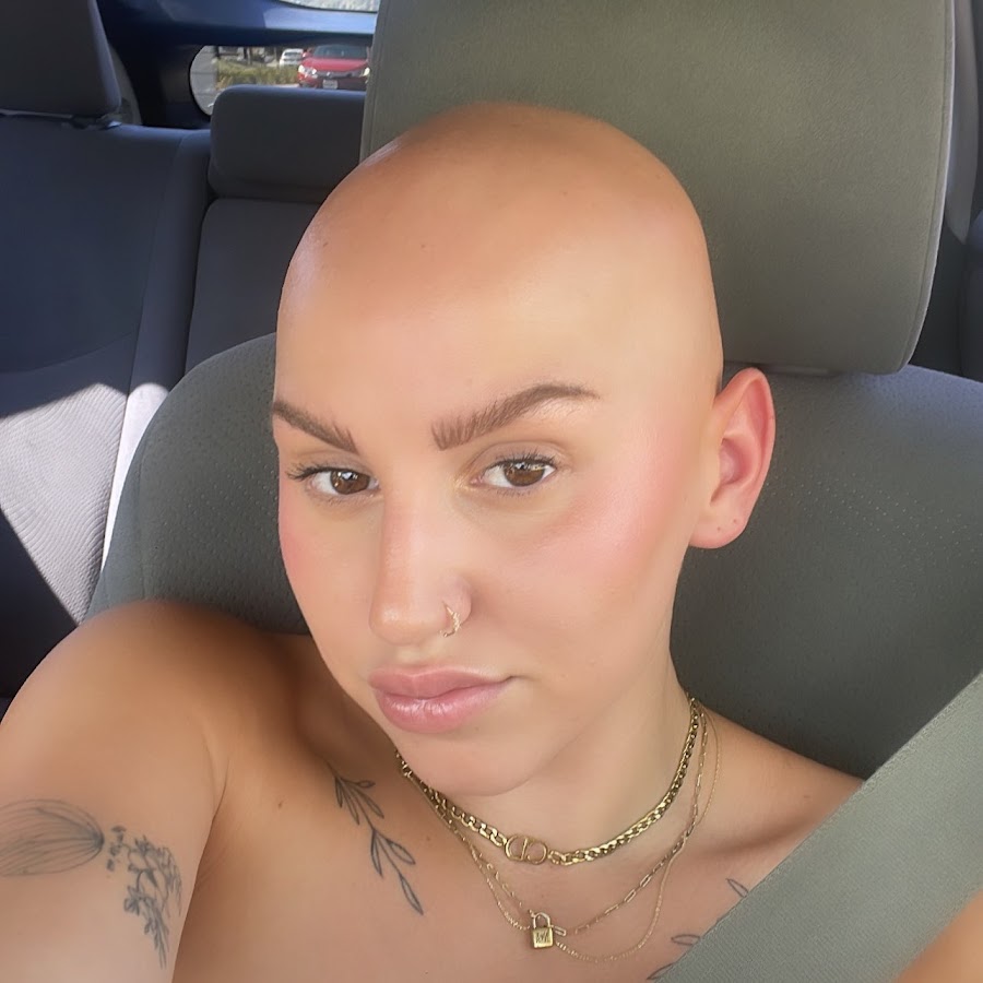 Why is alexyoumazzo bald