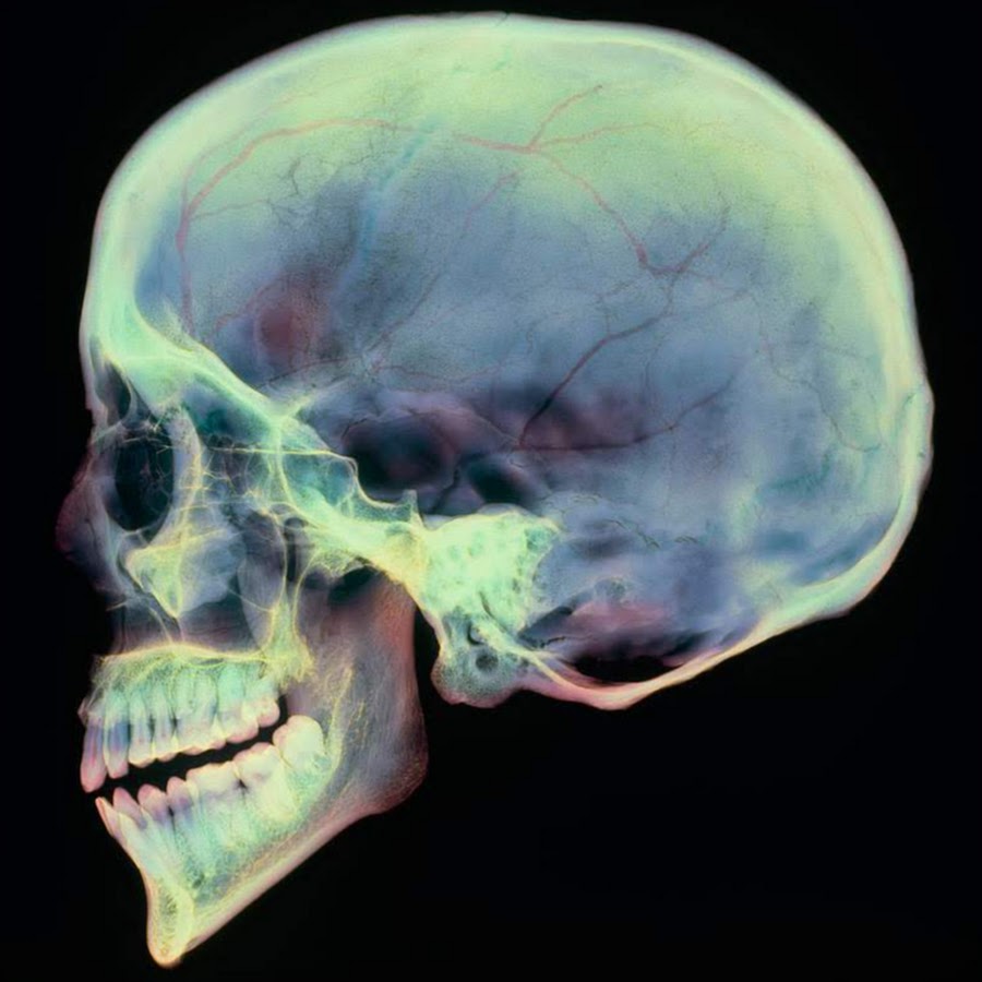 Череп разрыв. Рентген черепа человека сбоку. Тангенциальный рентген черепа. Рентгеноанатомия костей черепа.
