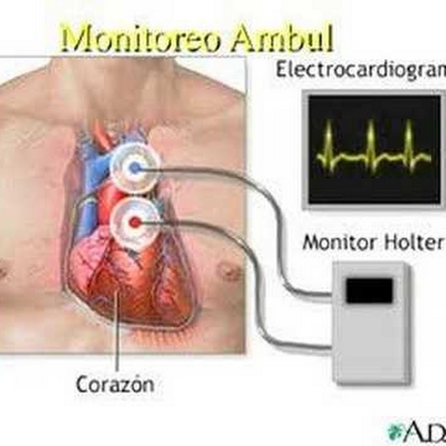 Сердечный холтер. Холтеровское мониторирование сердца. Холтер ЭКГ. Холтеровское мониторирование ЭКГ. Монитор на сердце.