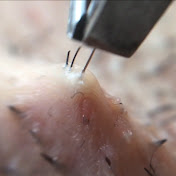 Hair Removal 脇毛全抜き Tweezers Microscope Youtube