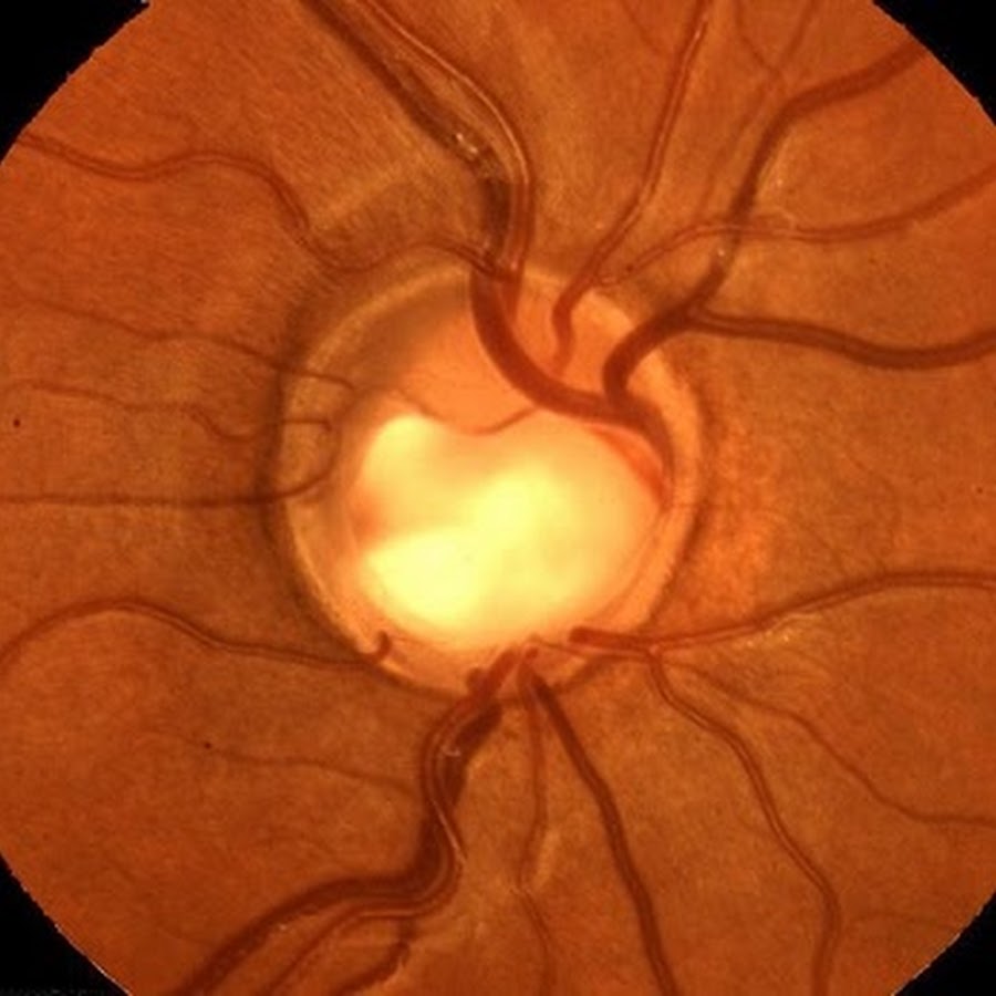 Сужение сосудов глаз. Экскавация зрительного нерва при глаукоме. Глаукоматозная атрофия зрительного нерва.