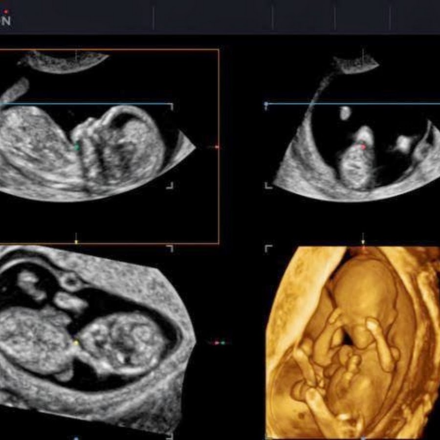 скрининг узи обычный узи